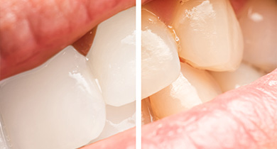 天然の歯が変色する原因
