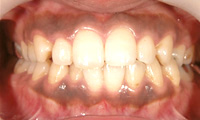 歯ぐきをきれいなピンク色に～レーザー治療～