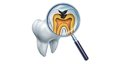 虫歯の痛みを放置することのリスク