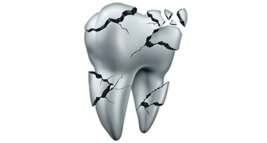 歯科用金属と口腔内環境