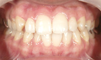 歯ぐきをきれいなピンク色に～レーザー治療～